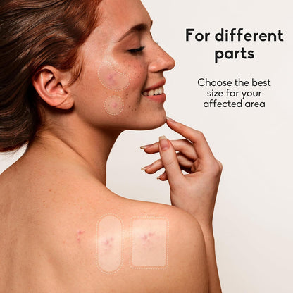 Zavlyra Pimple Patches for Face – Hydrocolloid Acne Spot Treatment