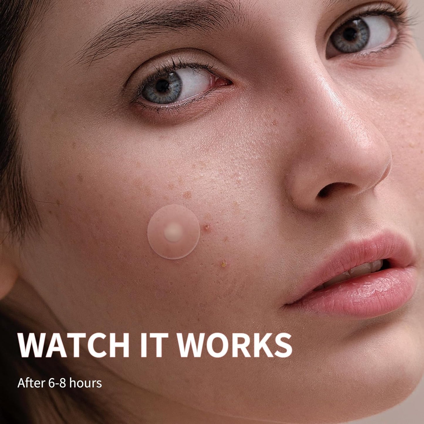 Zavlyra Pimple Patches for Face – Hydrocolloid Acne Spot Treatment